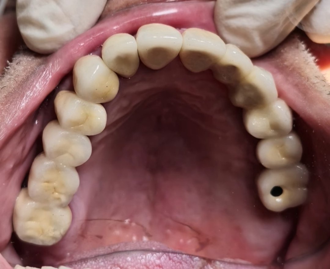 Full Mouth Rehabilitation Case