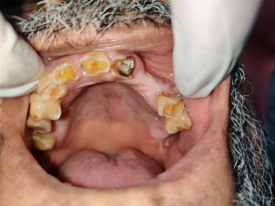 Full Mouth Rehabilitation Before Treatment