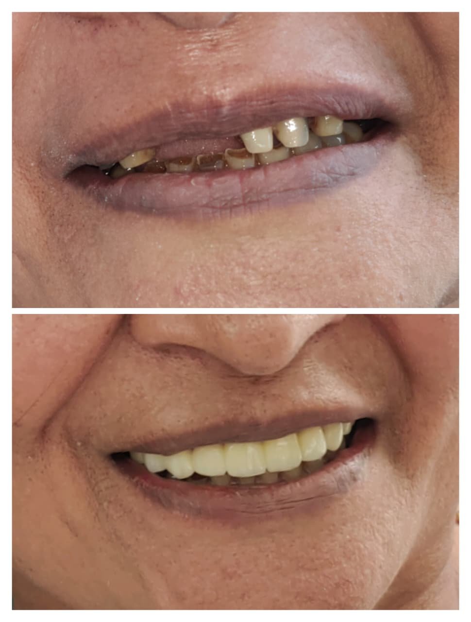 Smile Designing Smile Arc Before and After