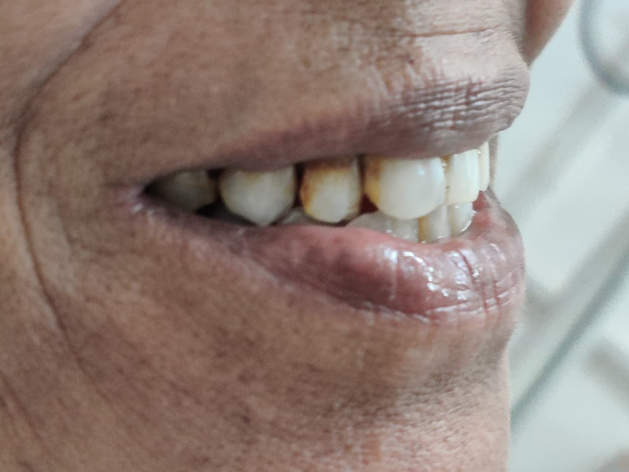 Smile Designing Completed Transformation
