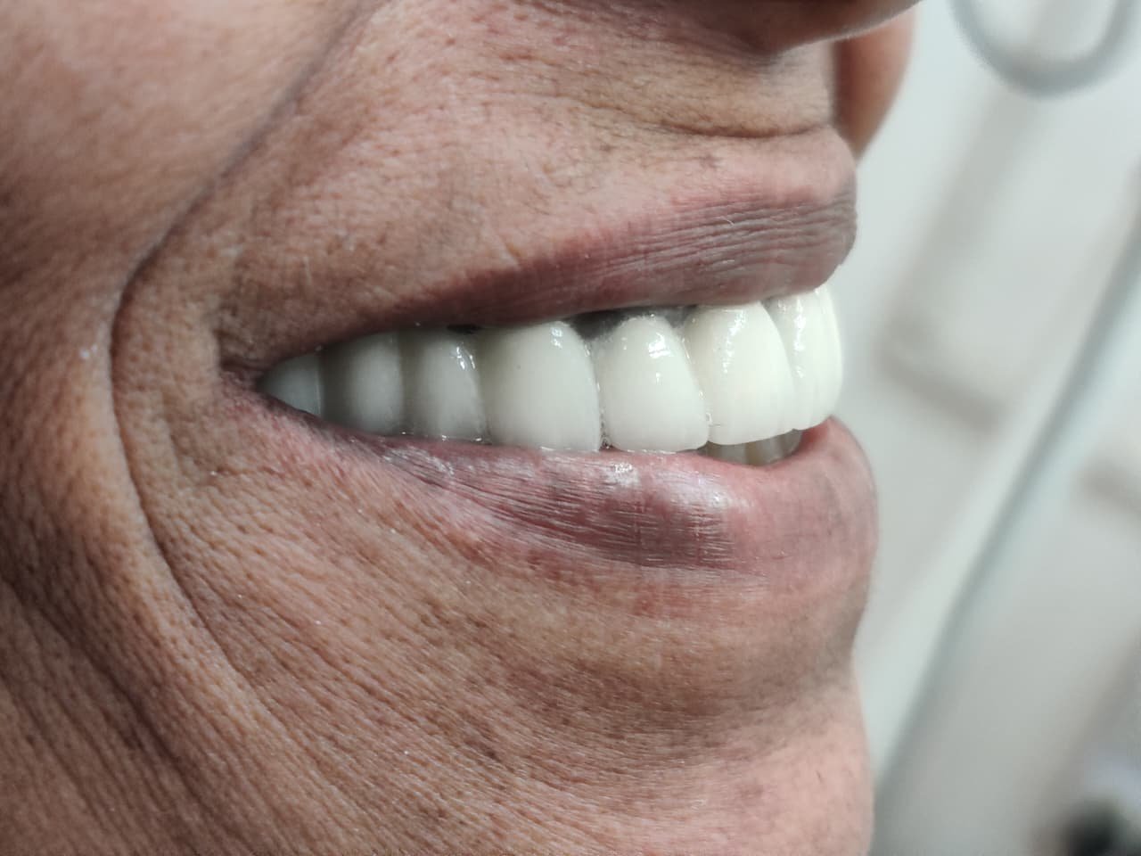 Smile Designing Lateral View