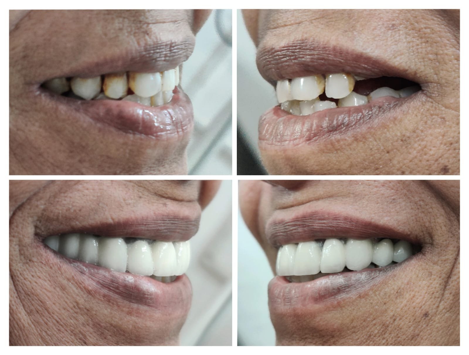 Smile Designing Alpha Dental Care