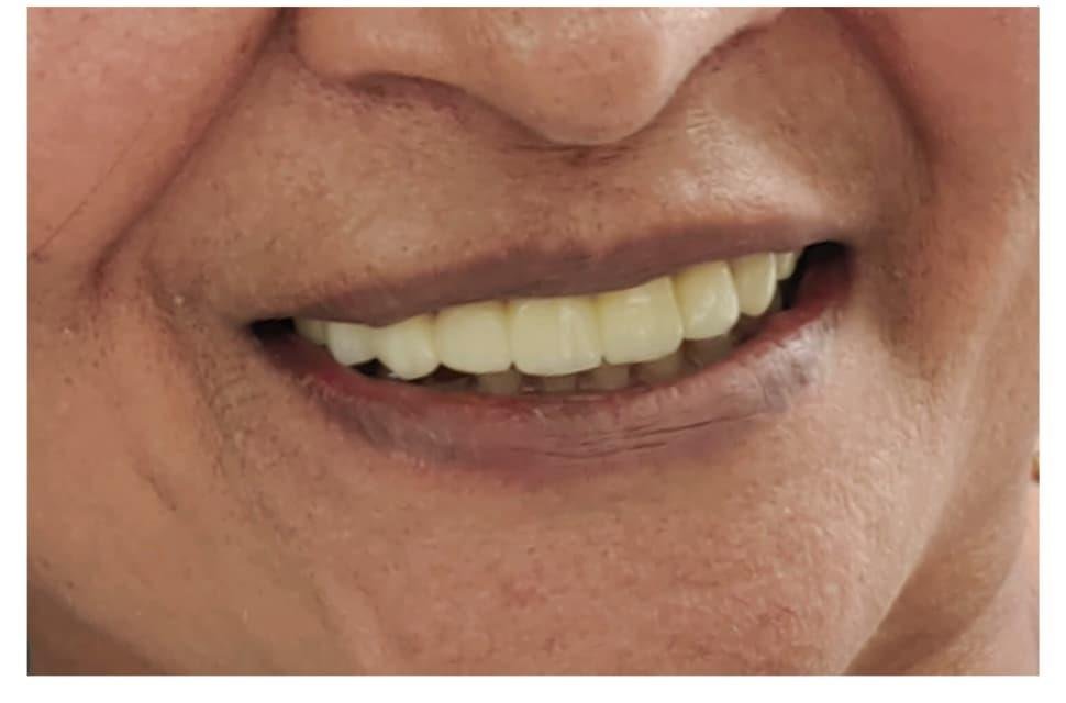 Smile Designing Case After Treatment