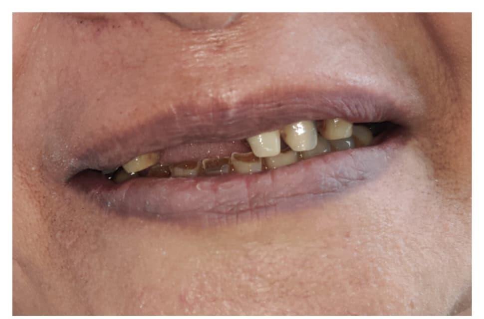 Smile Designing Case Before Treatment
