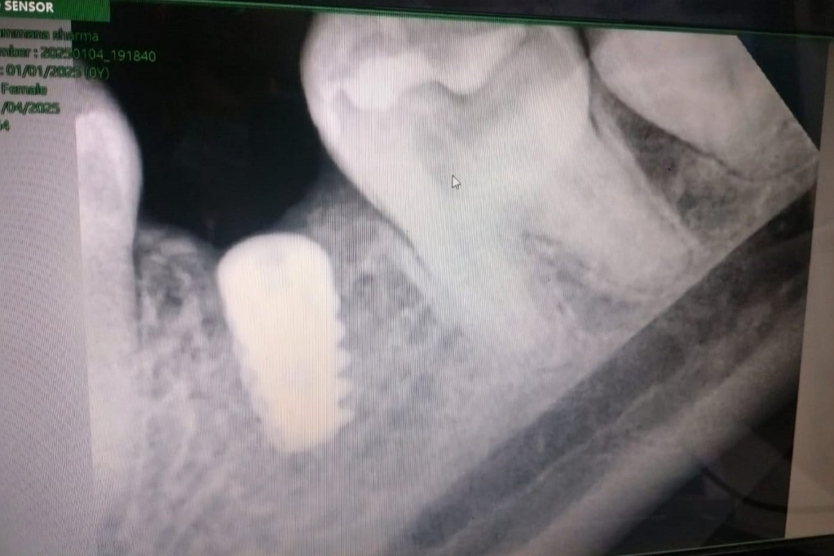 Dental Implants Salunkhe Vihar